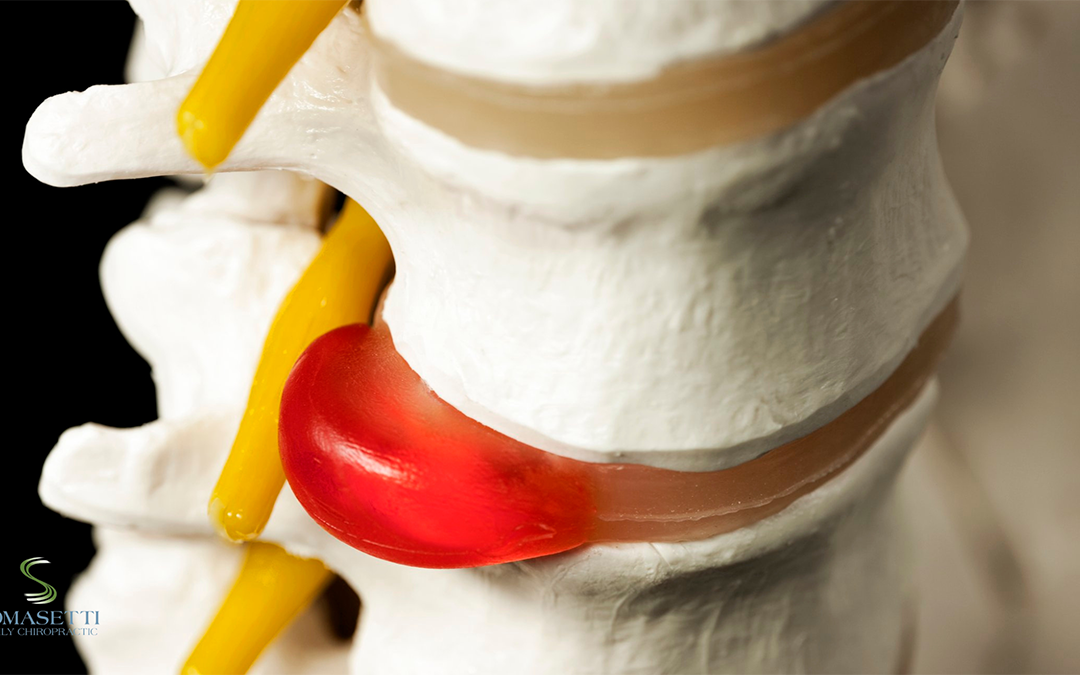 What is a Disc Injury?
